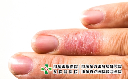 摄图网_326074025_皮肤过敏性皮质拉什埃切马指表皮皮疹剥皮卫生湿疹保健过敏手指伤口疼痛（企业商用）