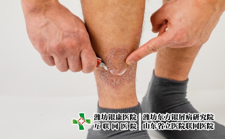 摄图网_506357587_对腿部的过敏皮疹施用治疗药膏（企业商用）