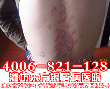 女性牛皮癣患者生理期的饮食