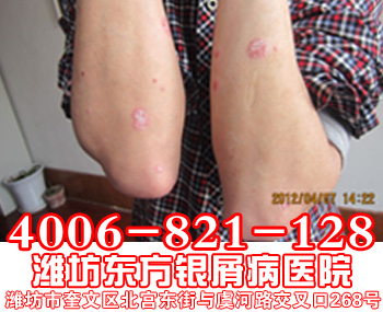　儿童牛皮癣日常护理