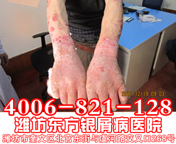 牛皮癣患者手部