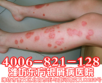 牛皮癣患者腿部