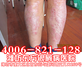 牛皮癣患者腿部