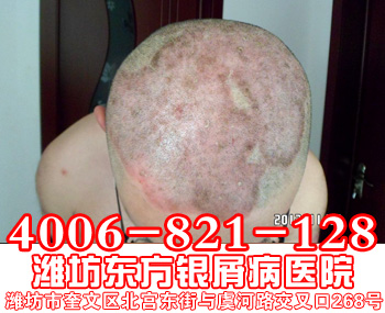 牛皮癣患者头部