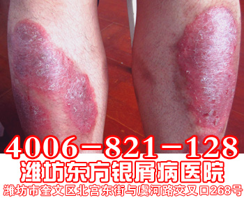 牛皮癣患者腿部