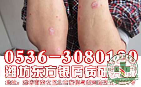 牛皮癣光疗个体化方案介绍