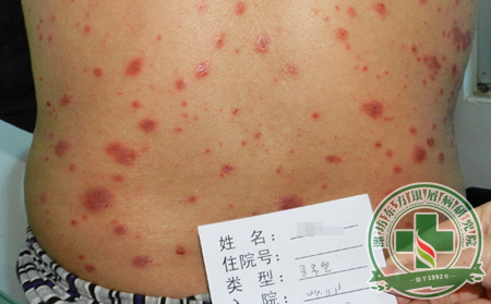 银屑病护理