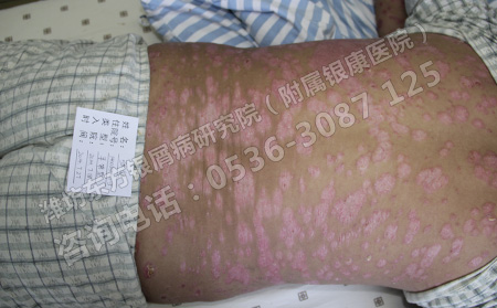 怎么治疗银屑病效果良可以