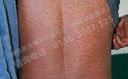春季怎样护理牛皮癣