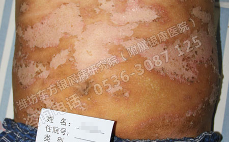 青岛牛皮癣治疗良可以的医院