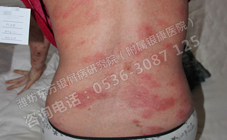 青少年为什么也会患上银屑病?
