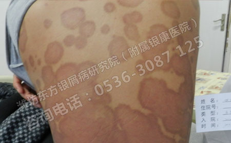银屑病怎么治治疗效果果更可以呢