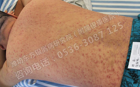 男性银屑病患者要怎么治疗可以？