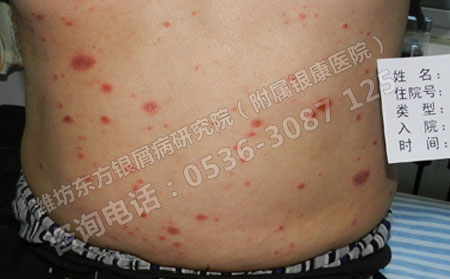 治疗银屑病该注意些什么