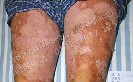 银屑病正确的治疗方法都哪些