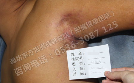 银屑病的治疗一般需要多长时间