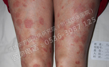 女性银屑病患者不能做的事情
