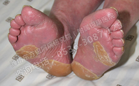 生活中如何加强对银屑病的护理