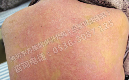 治疗银屑病有哪些比较可以的方法呢？