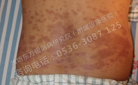 患上银屑病该从哪些方面做可以日常护理