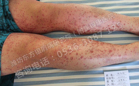 老年银屑病患者如何护理可以病情呢