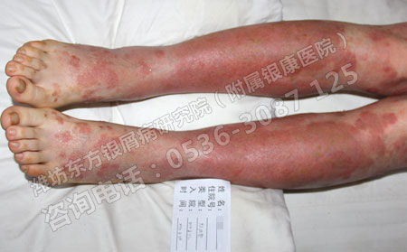 牛皮癣患者如何做可以护理减少伤害