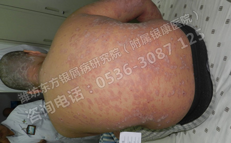 预防牛皮癣要做可以哪些方面的工作呢
