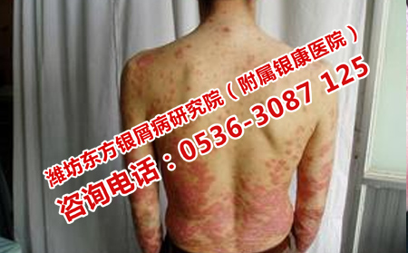 银屑病护理有什么技巧
