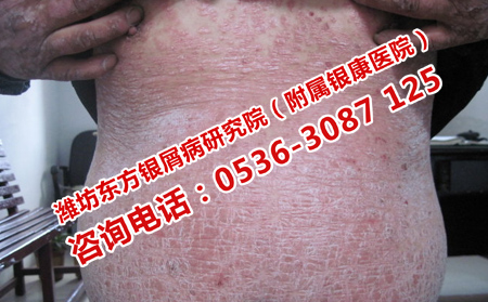 怎样谨慎治疗银屑病