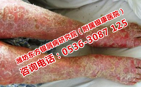 哪种方法治疗牛皮癣较有效
