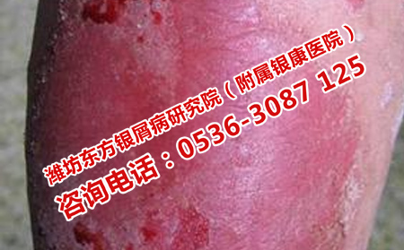 治疗牛皮癣有什么可以方法