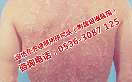 预防牛皮癣要有的方法
