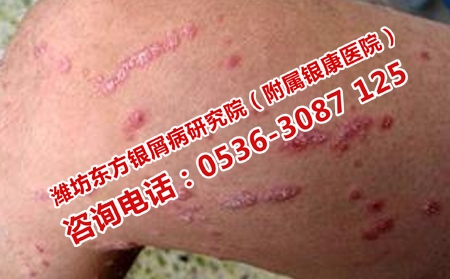 治疗牛皮癣的难点问题怎么办