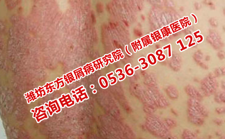 牛皮癣患者怎样护理肌肤