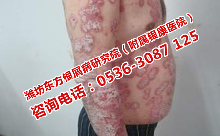 男性银屑病如何进行有效的治疗