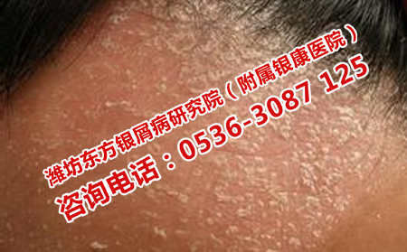 如何消除面部牛皮癣