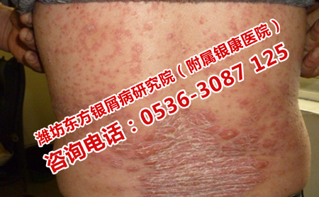 全身银屑病初期能自己可以吗
