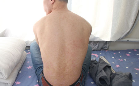 背部银屑病症状,初期背部银屑病症状