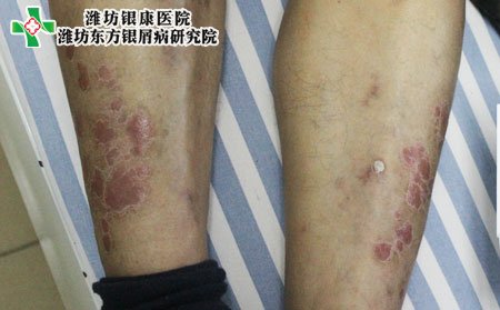 牛皮癣治疗方法,有牛皮癣怎样治疗